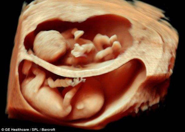 twins-3d-ultrasound
